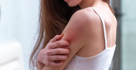 Kobieta z problemem skórnym na ramieniu - jak dbać o skórę z problemami
