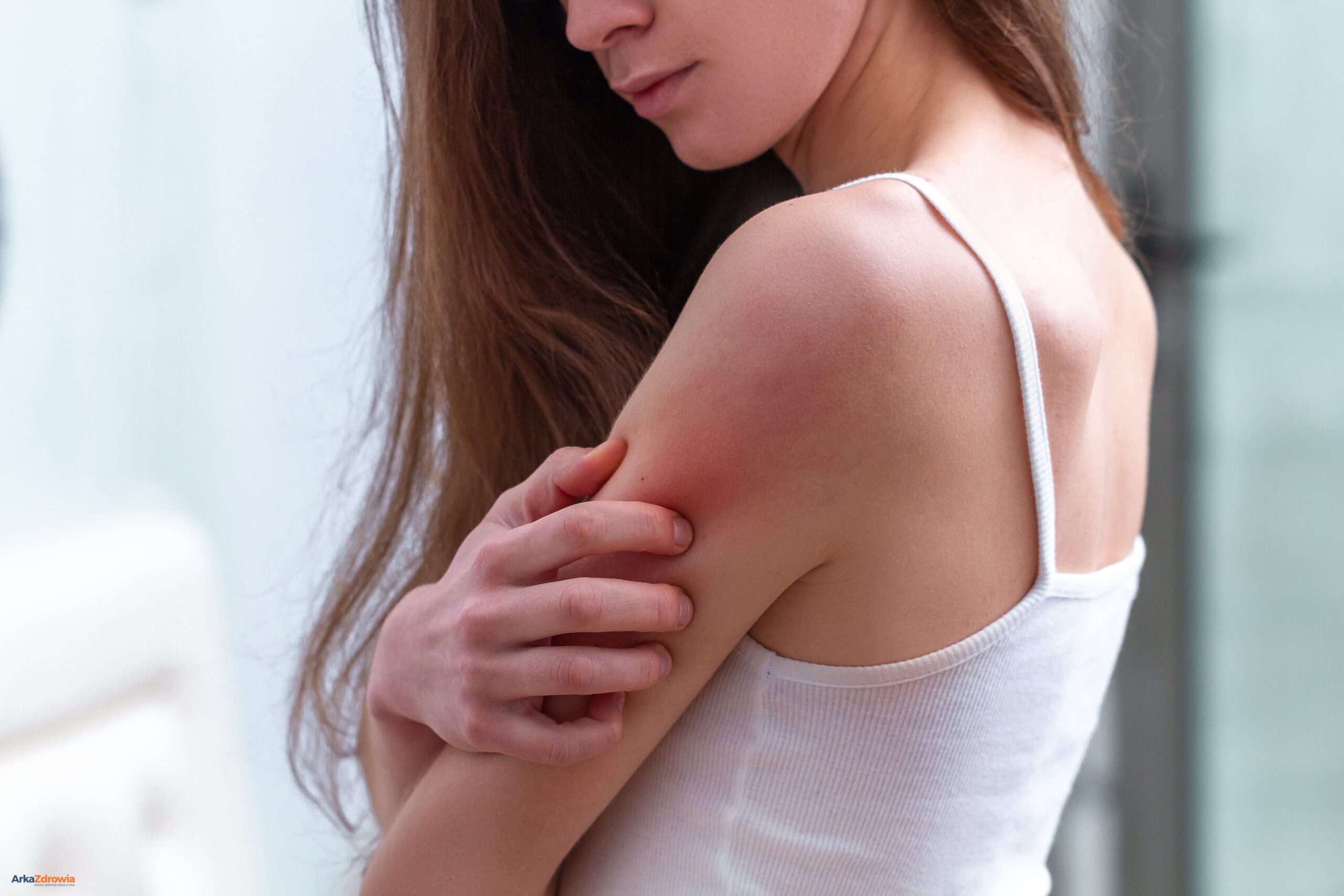 Kobieta z problemem skórnym na ramieniu - jak dbać o skórę z problemami